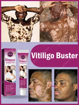 Регенериращ крем от Витилиго Оригинален Избелващ Крем от Витилиго Пряко промяна на Цвета при атаката, няма нужда да се притеснявате за кожата на бяла дъска
